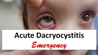 Acute Dacryocystitis Emergency [upl. by Eelanna]