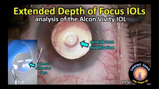 Alcon PanOptix Trifocal IOL Tips amp Tricks for Cataract Surgery [upl. by Idnod]