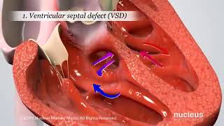 Blue baby heart defect ampTetralogy of Fallot [upl. by Leiso143]