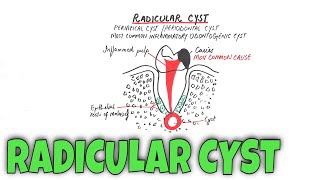 Radicular cyst  Periapical Cyst  Pathogenesis Clinical RF HF amp Treatment [upl. by Carolus]