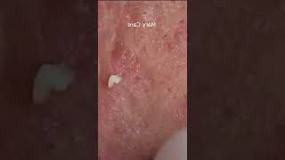 Pickel Ausdrücken Spa  Blackheads Akne amp Mitesser entfernen 🔴 78 [upl. by Damaris629]