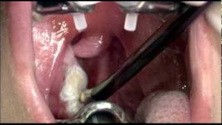 Tonsil Cryptolysis to Address Tonsil Stones [upl. by Thomasina]