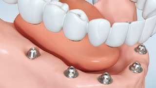 Remplacement de toutes les dents  prothèse fixe  le saviezvous [upl. by Flemming36]