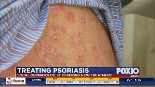 New treatment for psoriasis [upl. by Hollyanne922]