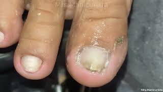 Toenail Ingrown Removalsulit sa dami ng Dry skin [upl. by Andrea]