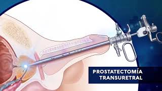 ¿QUÉ ES UNA PROSTATECTOMÍA ¿QUÉ TIPOS DE CIRUGÍA DE PRÓSTATA EXISTEN [upl. by Solenne]