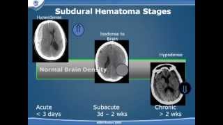 Traumatic Brain Injury Part 2 [upl. by Jollenta]