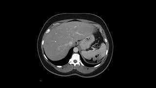 Retroperitoneal Leiomyosarcoma [upl. by Verile]