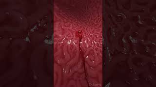 Bleeding gastric ulcer 3d animation anatomy meded [upl. by Ahselrac925]