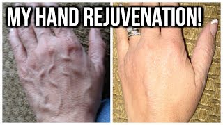 💝 HOW TO TREAT HAND VEINS 💝 [upl. by Ahsuoj77]