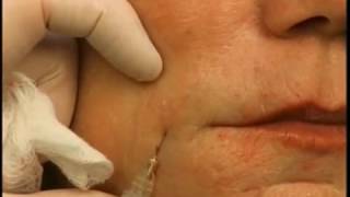 How to Lift Mouth Corners amp Marionettes With A Dermal Filler [upl. by Nylavad]