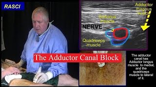 The Adductor canal block [upl. by Hillel]