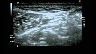 Posterior Tibial Nerve Block Ultrasound guided [upl. by Awhsoj577]