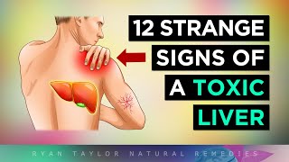 12 Strange Signs Your LIVER Is TOXIC [upl. by Aurita]