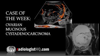 Serous vs mucinous cystadenoma left ovary Left ovarian septate cyst ultrasound and color Doppler [upl. by Barrington]