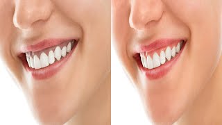 How To Get Rid Of Black Gums Naturally At Home [upl. by Myrah]