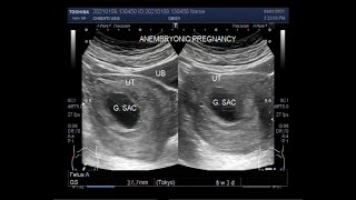 A Blighted ovum also called Anembryonic pregnancy [upl. by Anaher]