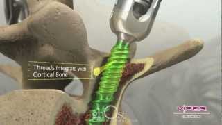 Ghost Productions  DePuy Cortical Fix Screw [upl. by Yerdua]