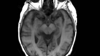 Hepatic Encephalopathy [upl. by Chlo]