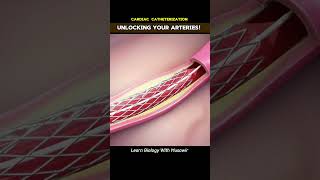 unlocking Your Arteries Cardiac Catheterization cardiology [upl. by Ynohtnacram]