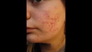 Accutane Before and After [upl. by Torray]