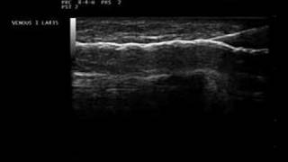 Sclerotherapy Biosound Esaote MyLab Ultrasound Guided [upl. by Adyam]