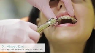 Cum se scoate un aparat dentar fix  ORTO IMPLANT EXPERT [upl. by Max337]