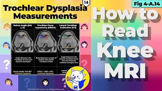 Fig 4A14 Trochlear Dysplasia Assessment Measurements [upl. by Elliot]