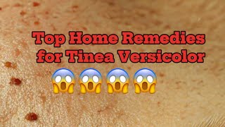 Top Home Remedies for Tinea Versicolor [upl. by Renelle]