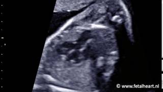 Fetal heart Academy  Tetralogy of Fallot 1 LVOT [upl. by Buzzell767]