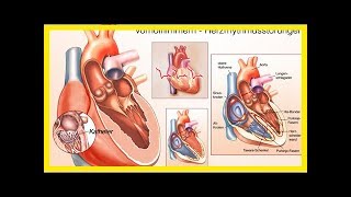 Herzrhythmusstörungen Neue heilende Therapie gegen Vorhofflimmern [upl. by Bernarr]