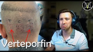 My opinion on Verteporfin  Unlimited Hair Follicles [upl. by Short]