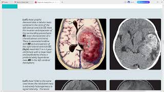 NEOPLASMS BRAIN DIAGNOSTIC IMAGING SERIES [upl. by Nelyak592]