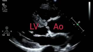 Unicuspid Aortic Valve  Echo Clip [upl. by Nodearb951]