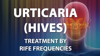 Urticaria Hives  RIFE Frequencies Treatment  Energy amp Quantum Medicine with Bioresonance [upl. by Eiggam640]