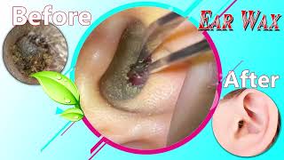 Ear Wax Removal Myths Debunked What You Need to Know 015 [upl. by Lek]