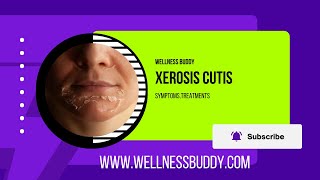 Xerosis Cutis Severe Dry Skin Calluses and Fissures [upl. by Yelra]