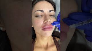 Lips Filler Treatment by our Cathy  Ageless MD [upl. by Anawt]