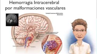 HEMORRAGIA INTRACEREBRAL CONCEPTO Y CLASIFICACIÓN [upl. by Kevan90]