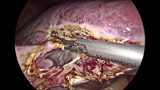 Laparoscopic Hydatid Cyst Excision  Liver Hydatid cyst Laparoscopy [upl. by Dadivitan]