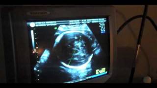 My Growth Scan Follow Up Ultrasound [upl. by Ko934]