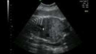 Life in the Womb IV 33 weeks ultrasound [upl. by Anairuy99]