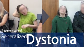 Dystonia  Generalized Dystonia  사경증  전신사경증 [upl. by Durston]