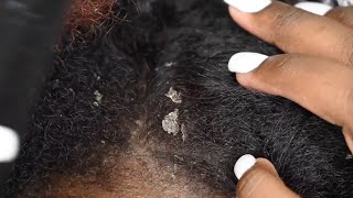 BIG FLAKES  Dry Flaky Scalp  Scratching Dandruff ASMR Ep10 [upl. by Sokem767]