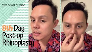 Rhinoplasty In the Philippines 8th Day Post Opp [upl. by Helbon]