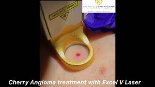 Cherry Angioma Treatment with Excel V Laser [upl. by Hgielra988]