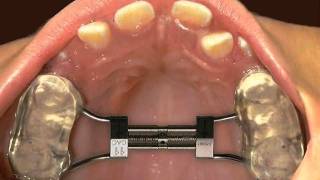 Hızlı üst çene genişletmesi Rapid Palatal Expansion [upl. by Em458]