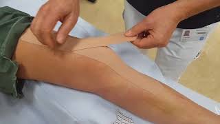 Medical taping één week na patella luxatie [upl. by Sasnak953]