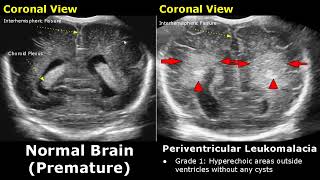 Neonatal Brain Ultrasound Normal Vs Abnormal Images  Full Term Infant amp Premature Newborn Head USG [upl. by Arateehc]