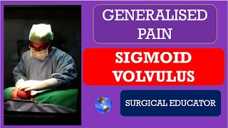 SIGMOID VOLVULUS How To DIAGNOSE amp TREAT Generalised Abdominal Pain [upl. by Ahtabbat]